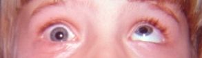 Entrapment_of_right_inferior_rectus_muscle_ENT_026.jpg