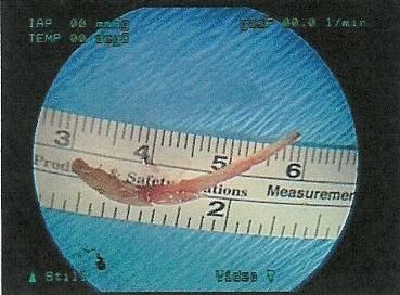 ForeignBodyFishBoneHypopharynx.jpg