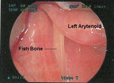 ForeignBodyFishBoneHypopharynxLabeled.jpg