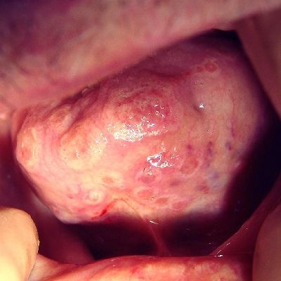 Mouth_Ulcers_Herpetiform_400SQ.jpg