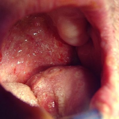 Mouth_Ulcers_Tongue_and_Palate_400SQ.jpg