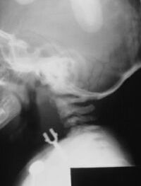 Foreign_Body_in_the_Esophagus_Lateral_200x263.jpg