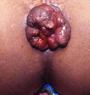 prolapsed-thrombosed-hemroids-hemorrhoids.jpg