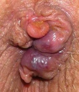 myhem-prolapsed-hemorrhoid-picture-257x300.jpg
