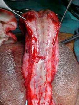 Penile Degloving: Peyronie's Disease Surgery, Fracture Repair and Injury - gr2