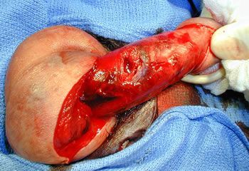 Penile Degloving: Peyronie's Disease Surgery, Fracture Repair and Injury - penile fracture surgery