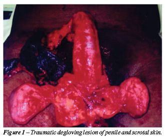 Penile Degloving: Peyronie's Disease Surgery, Fracture Repair and Injury - traumatic%20degloving