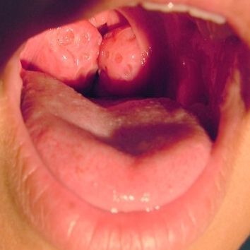 kissing_tonsils_354x354.jpg