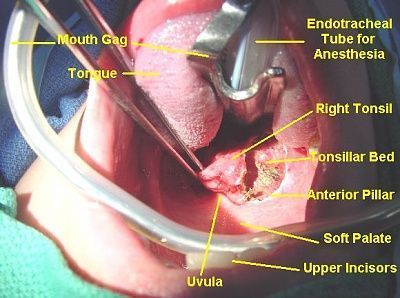 tonsillectomy_labeled_580x432.jpg