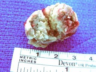 dermoid_cyst__surgical_specimen_320x240_.jpg