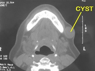 Name:  DERMOID_CYST_CT_LABELED_320x240.jpg
Views: 1951
Size:  61.0 KB