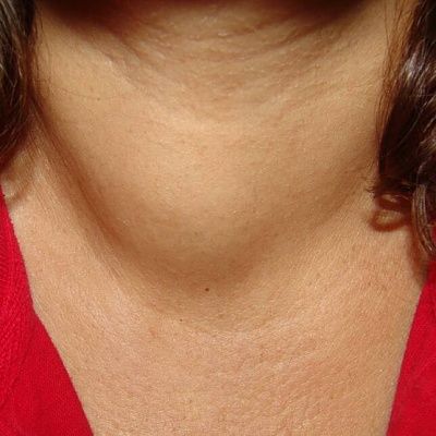 thyroid_mass_jun_08_sq.jpg