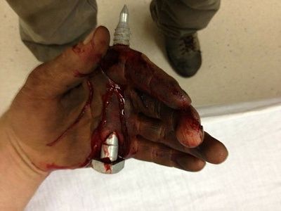 handinjury.jpg