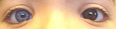 waardenbergheterochromia_cropped.jpg