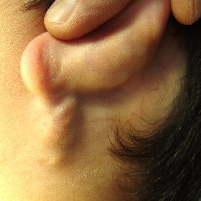 Name:  Pilomatrixoma_Face_400SQ_1_.jpg
Views: 1013
Size:  153.9 KB