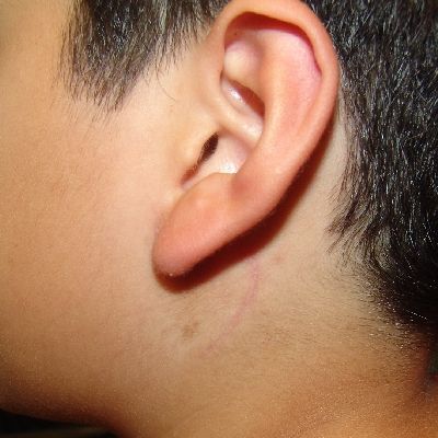 Name:  Pilomatrixoma_Scar_400SQ_1_.jpg
Views: 1283
Size:  165.2 KB