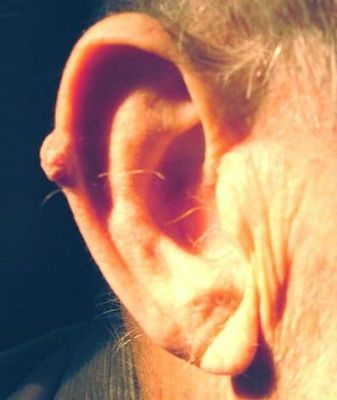 auricular_cyst2.jpg
