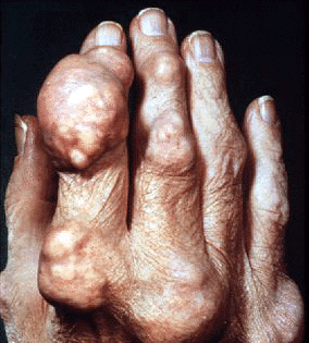 gout_feet.gif