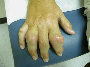 Gout3.gif