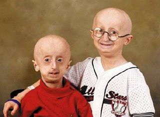 Hutchinson-Gilford Progeria Syndrome: Progeria Baby, Progeria Life Expectancy - HGPSx2A
