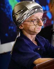 Progeria.jpg
