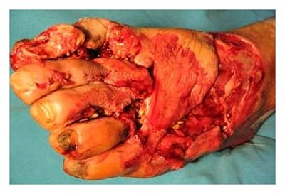 foot-20crush-20injury-20in-20a-20farmyard-20accident..jpg