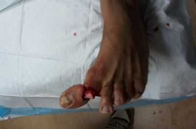 miguel-torres-toe-injury1.jpg