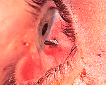eye-injury.gif