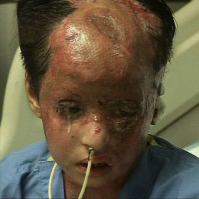 white_phosphorus_victim_afghanistan.jpg