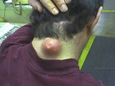 fucked-up-zit.jpg