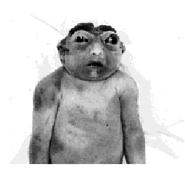 anencephaly.gif