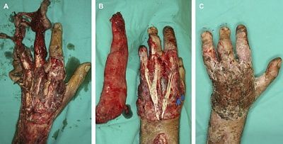 avulsion.jpg
