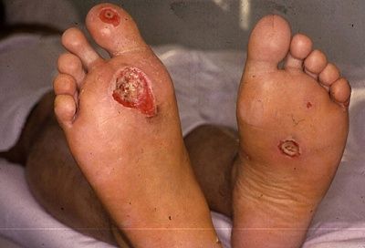 electrical-20burns-20-282-29.jpg