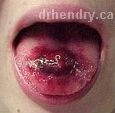 TongueInf.jpg