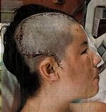 BrainAbscessPic437.JPG