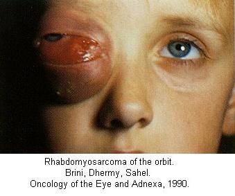 rhabdomyosarcoma of the orbit.jpg