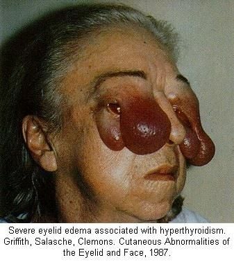 eyelide edema.jpg