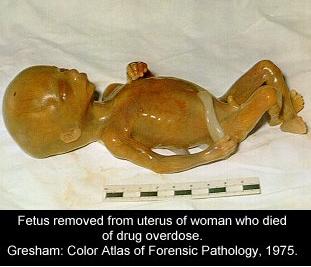 removed fetus.jpg