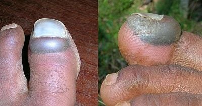 800px-toenailinjury.jpg