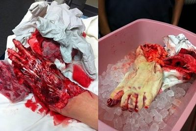 degloved.jpg