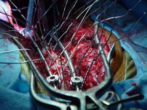 scoliosis%20surgery%20%282%29.jpg
