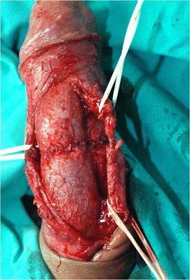 penile-20frac-20-282-29.jpg