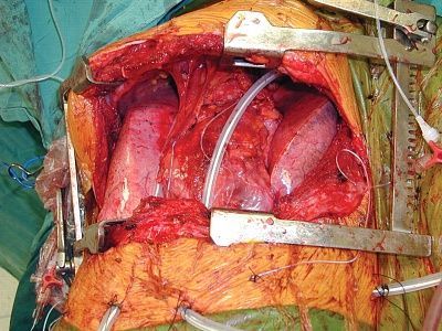 lung.jpg