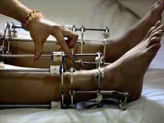 ap_leg_lengthening_080402_mn.jpg