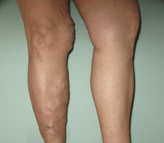Varicose%2520Veins%2520pic1.jpeg
