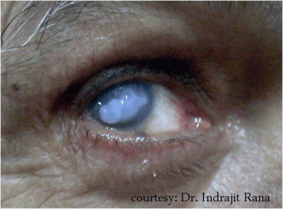 eye-20blist-20-281-29.gif