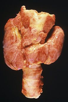 230px-Thyroid%2C_Diffuse_Hyperplasia.jpg