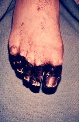 lack-20toes.jpg