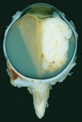 eye-20tumour.jpg