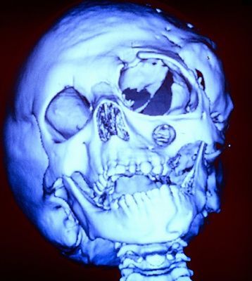 tumblr_lvctx8j5nb1qeo1dvo1_500three-dimensional-20ct-20scan-20of-20patient-20with-20neurofibroma.jpg